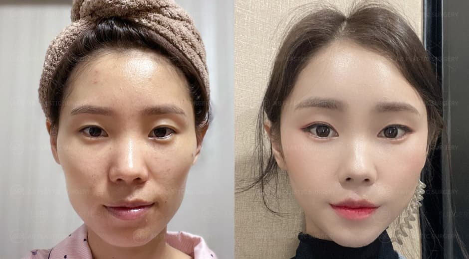 My glow up that I will never regret! <Facial Contouring All-3 set, Full Face Fat Grafting>