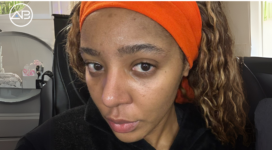 Ethnic Rhinoplasty Success: A Natural-Looking Result That Perfectly Complements My Features!