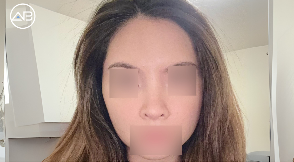 One Month Post-Op Update – My Transformation Journey!