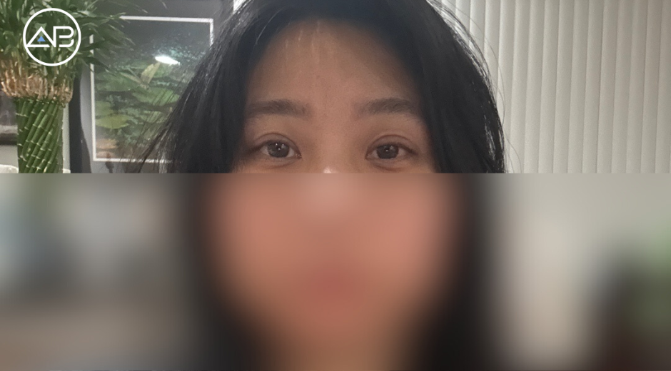 Thoughtful Care & Expertise: My Positive Experience with Revision Blepharoplasty in Gangnam