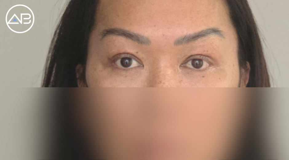 Revision eyelid in Korea for the first time!