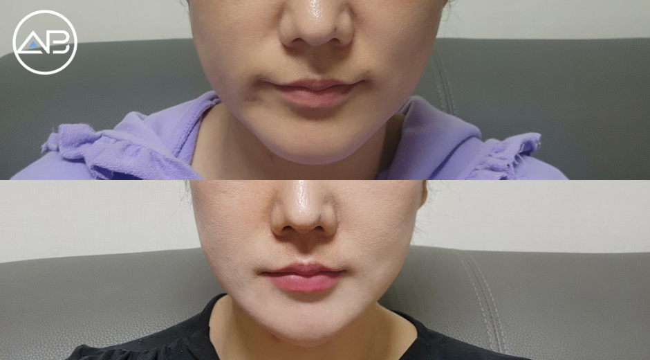 Got my philtrum done!