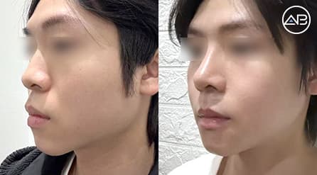 My Post-Surgery Journey: Contouring + Rhinoplasty