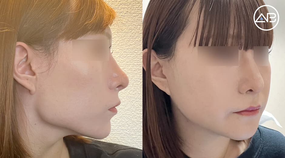 Friends Said WOW! My 3-Point Facial Contouring Result