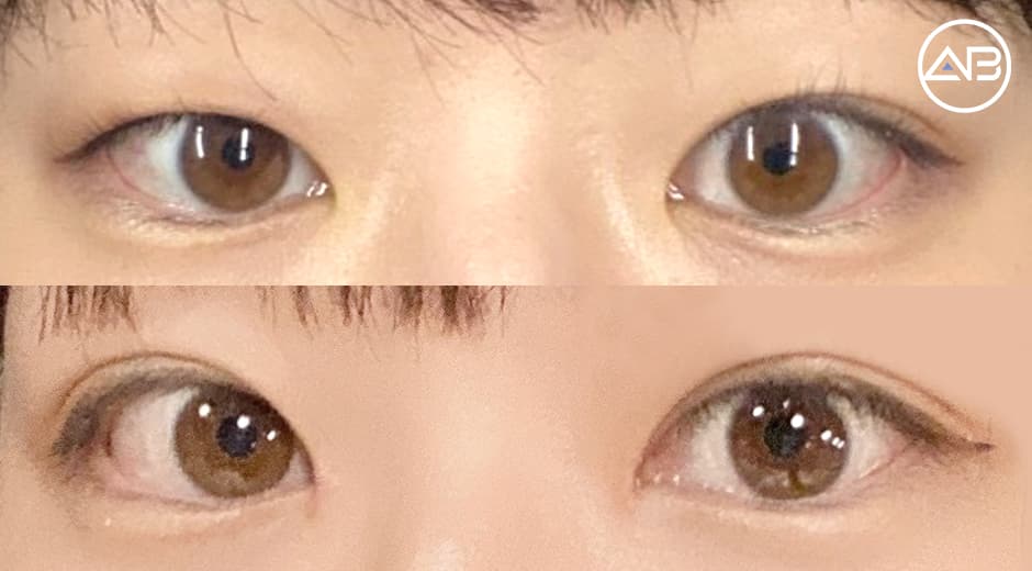 Why I’m Glad I Chose AB Plastic Surgery 🤍