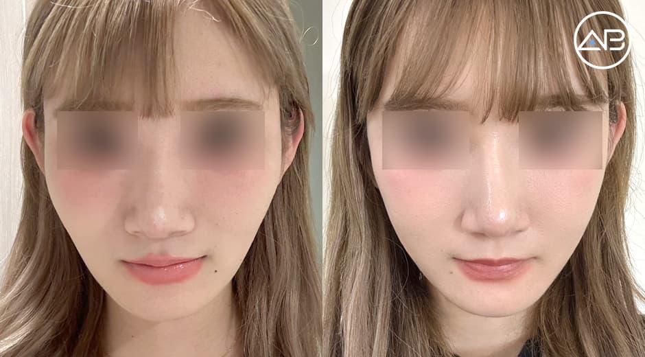 Two Months After My Zygoma Reduction Surgery!