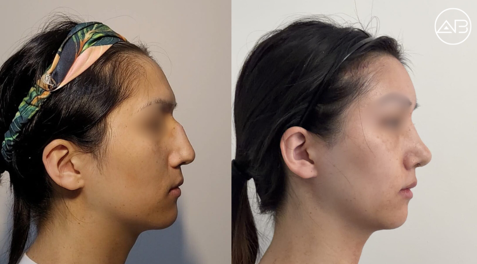 1.5 months post facial surgery with AB Plastic Surgery