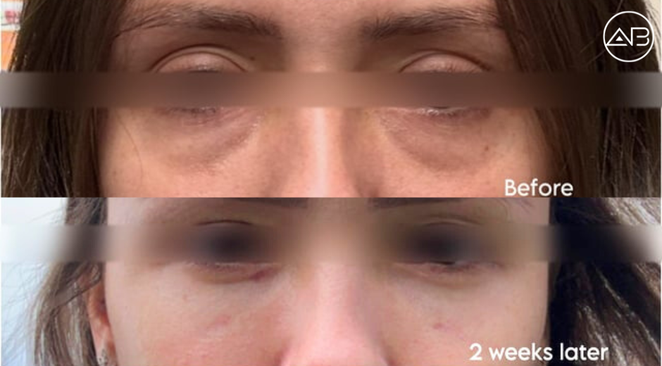 My real experience of my under-eye surgery in Seoul, South Korea / AB Clinic