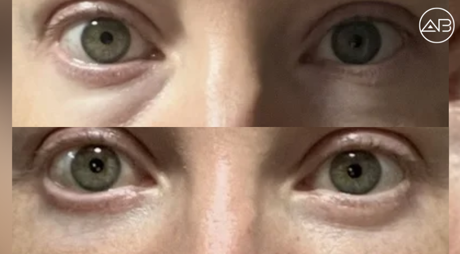 Lower Blepharoplasty Procedure