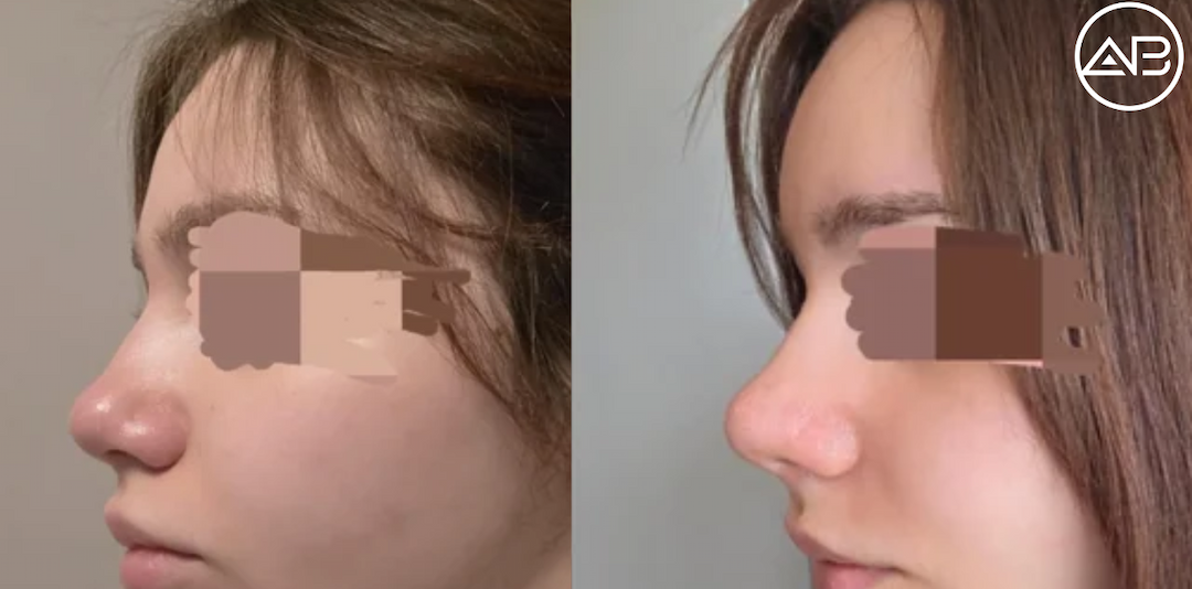Rhinoplasty and fatgrafting at Ab clinic gangnam