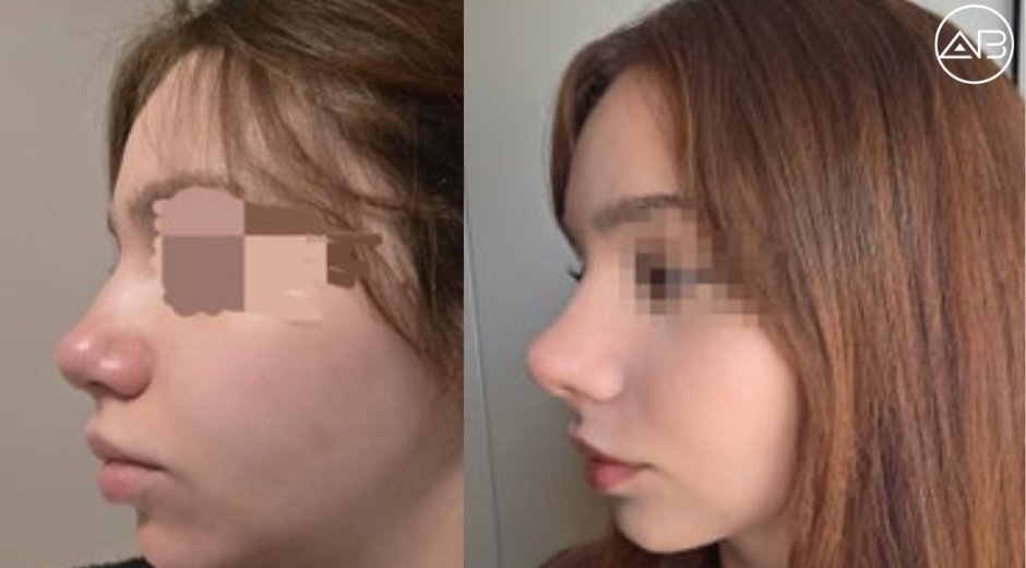 Rhinoplasty at AB