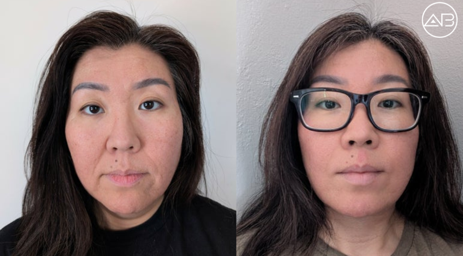 V Line Surgery and Facial Contouring Experience at AB Plastic Surgery