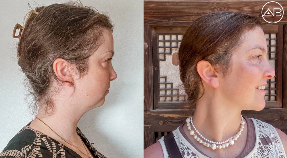 One Year After Cosmetic Surgery in Korea: The Honest Update Nobody Talks About