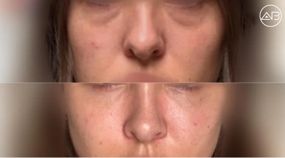 My experience of facial fat grafting/repositioning South Korea, Seoul
