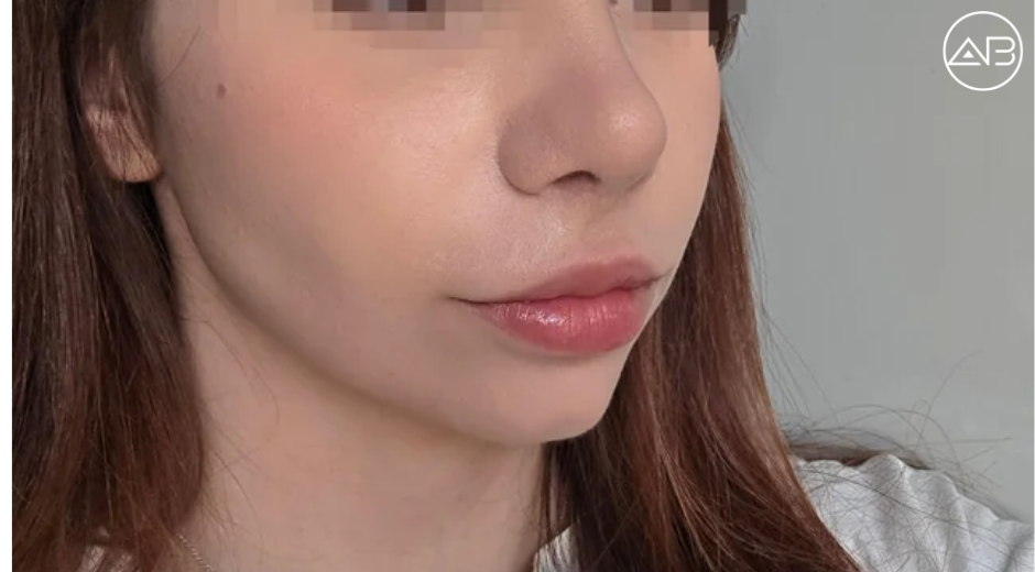Rhinoplasty and fatgraft at AB clinic