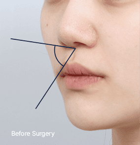 Before surgery
